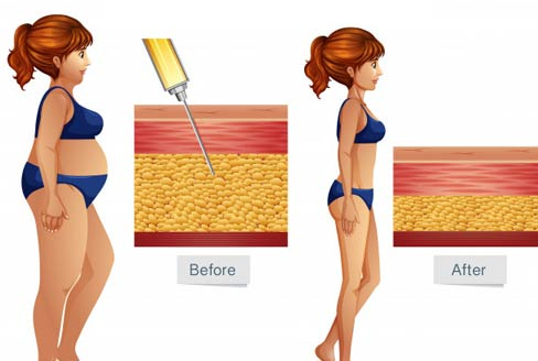 Body Contouring